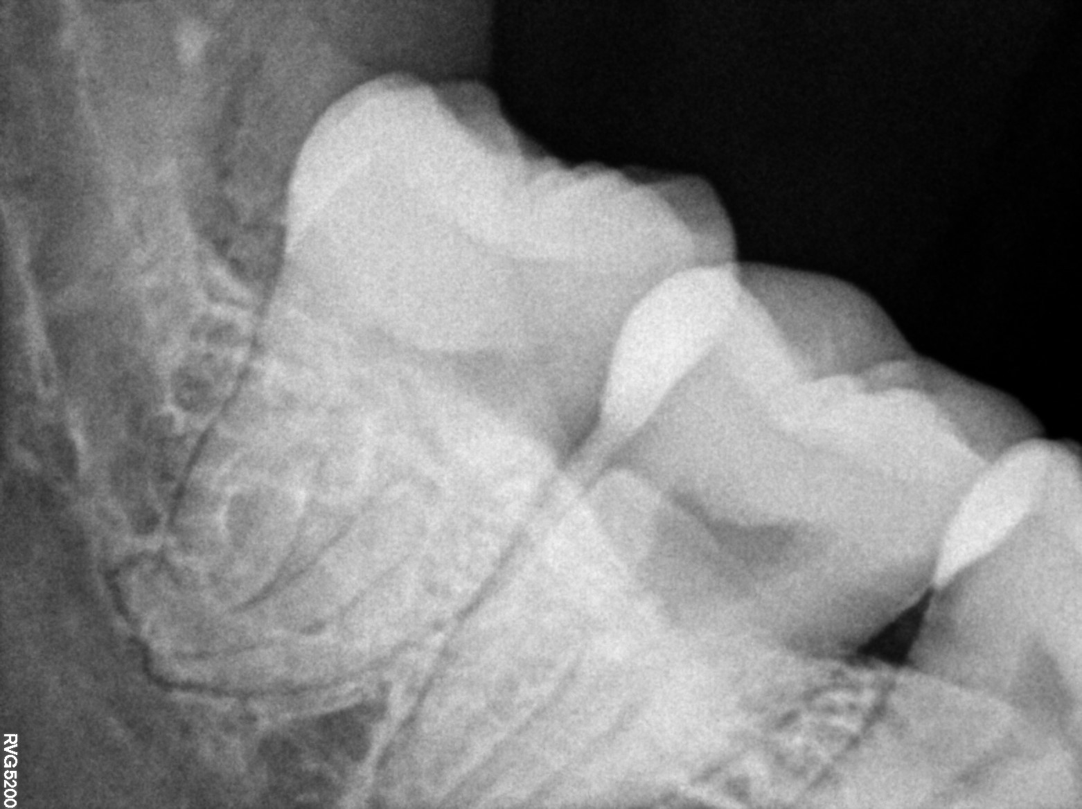 Dental X-ray